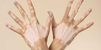 Specialisti a confronto sulla vitiligine: focus su diagnosi, cure e rete territoriale